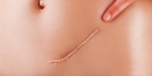 cicatrice et cicatrisation