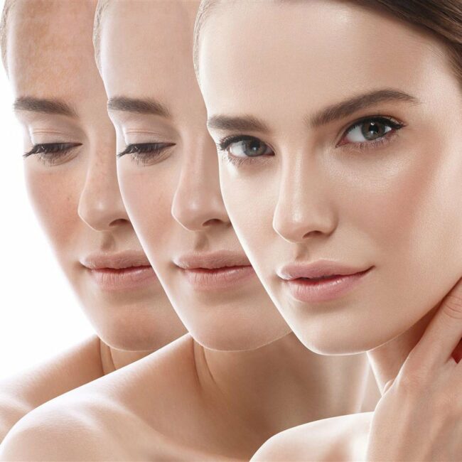 Atténuation des taches pigmentaires