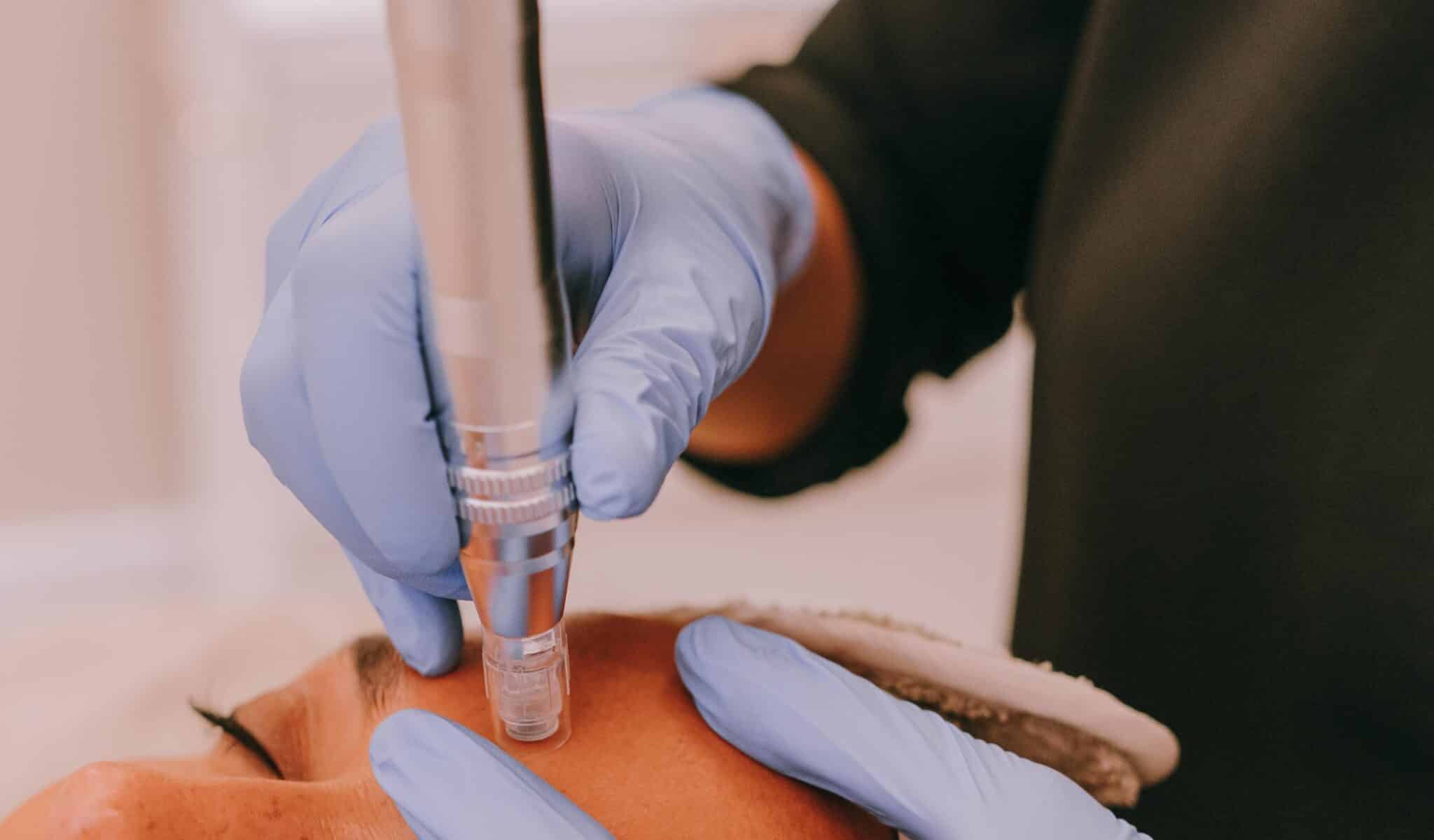 Nano needling Application du Nano-Needling qui stimule collagène et élastine